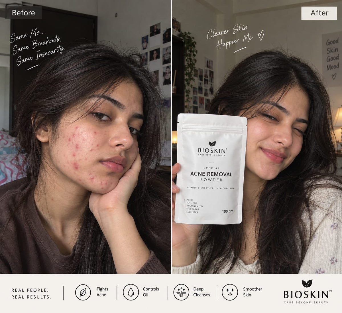 Acne removal face pack by Bioskin 100gm