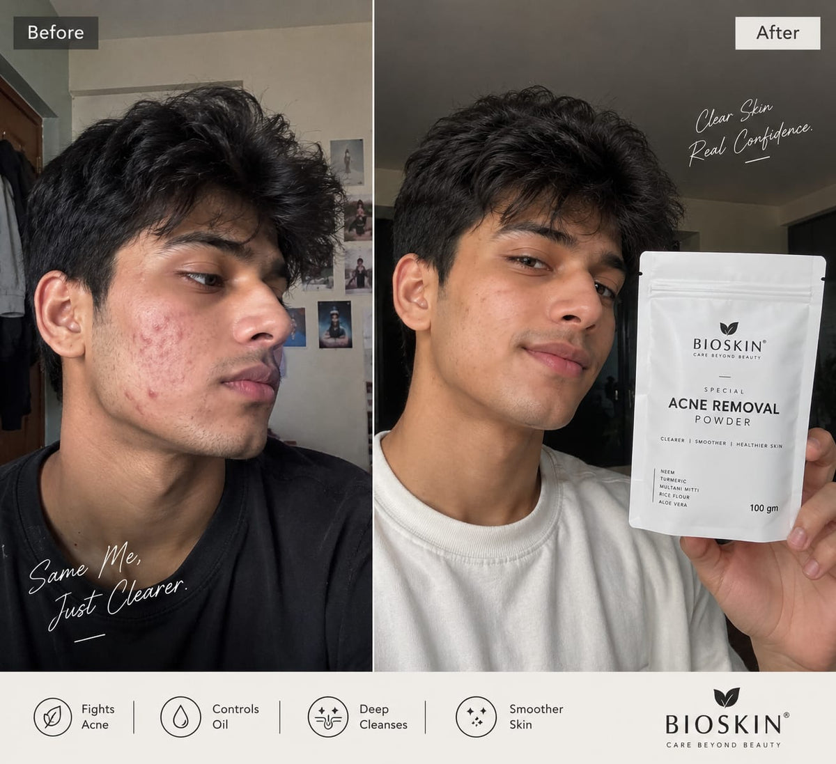 Acne removal face pack by Bioskin 100gm